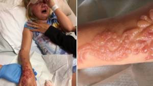 Siedmioletnia dziewczynka ma dotkliwie poparzoną rękę po tym jak zrobiła sobie t